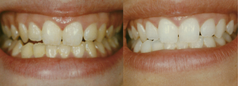 Whitening